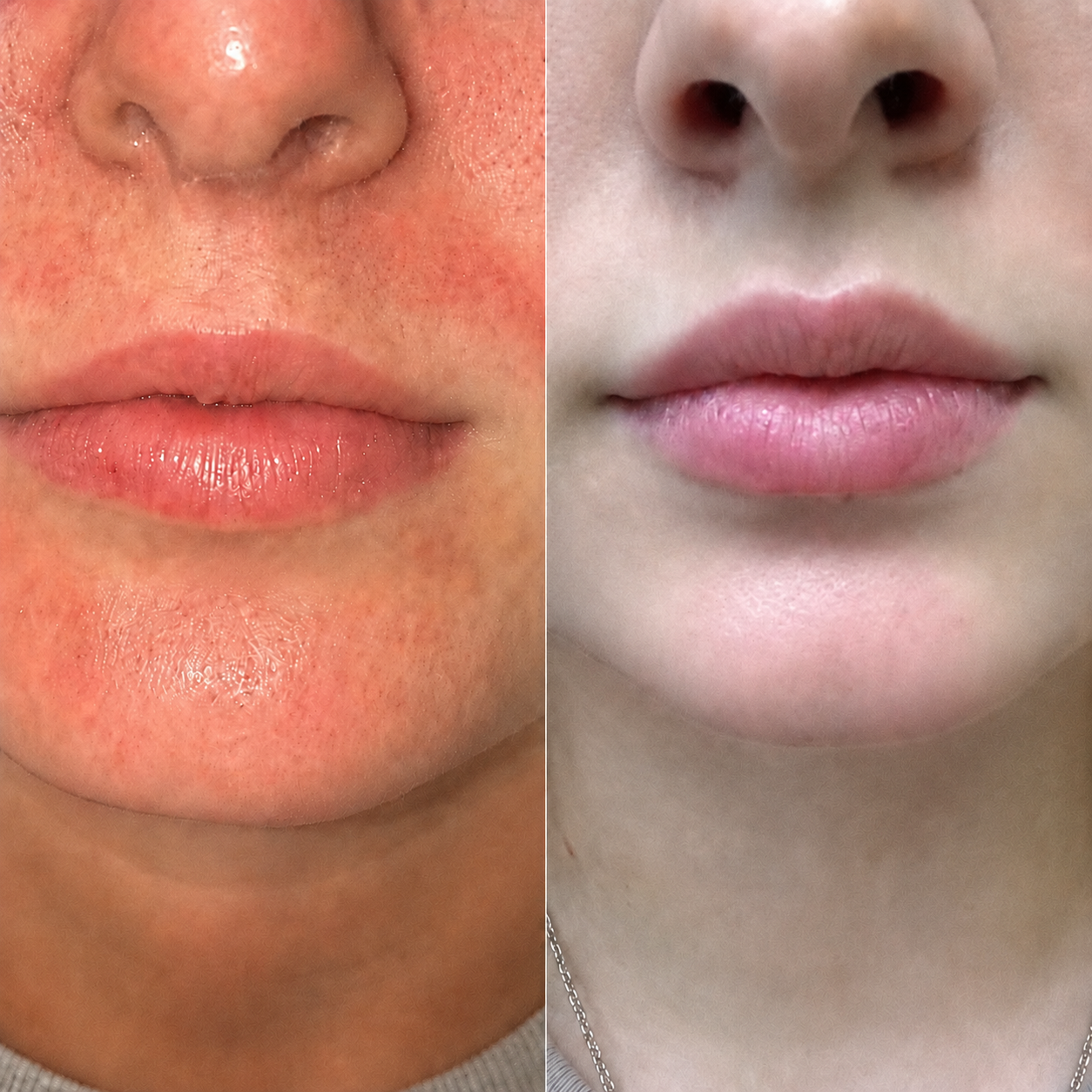 Skin before and after using Lavero shower filter